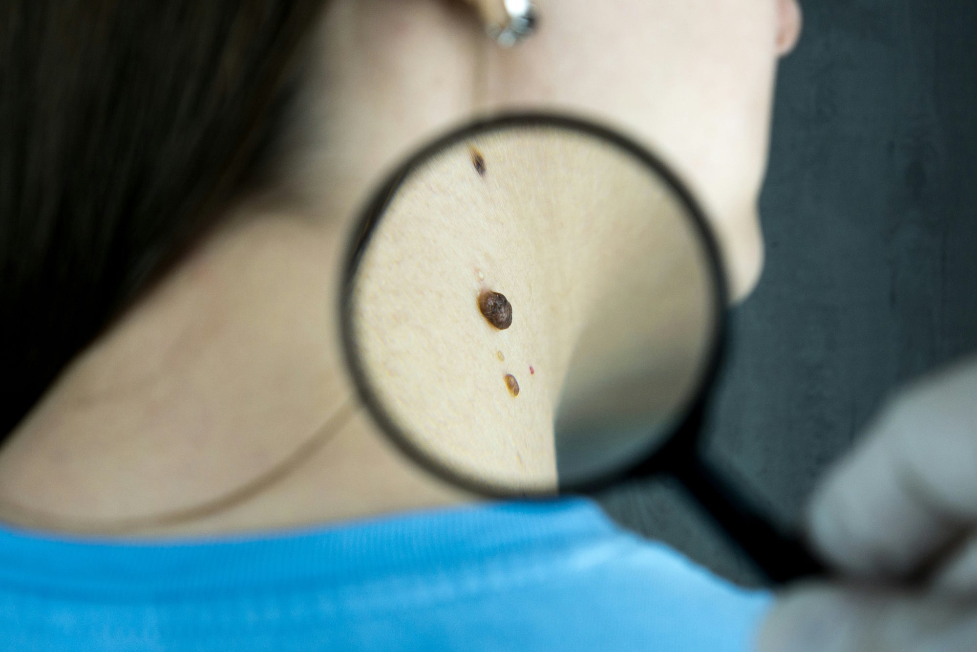 Remembering UV Safety Month: Protecting Our Skin and Celebrating Life